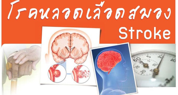 โรคหลอดเลือดสมอง (Stroke) อัมพฤกษ์-อัมพาต